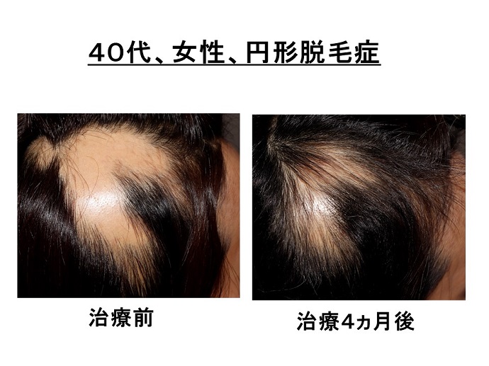 円形脱毛症　病院